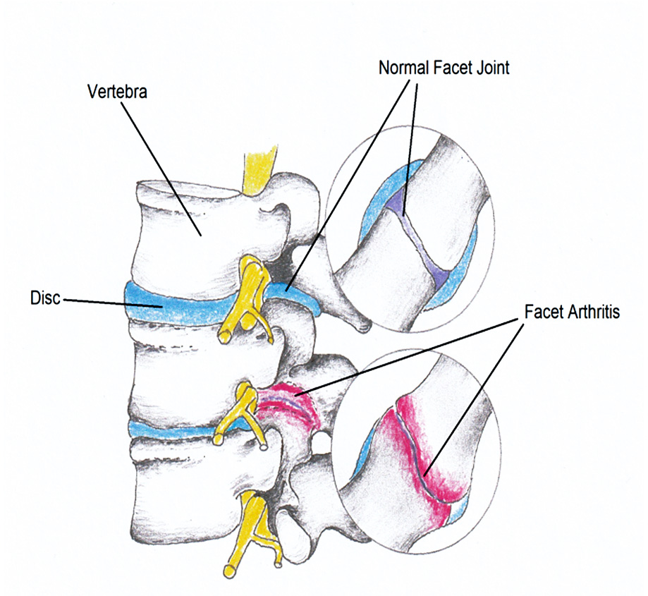 12 Treatments to Help Deal with Facet Joint Syndrome Pain